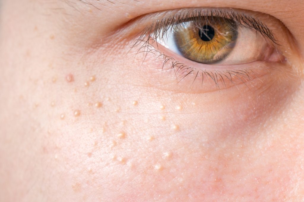 Milia (Milium) - pimples around eye on skin.