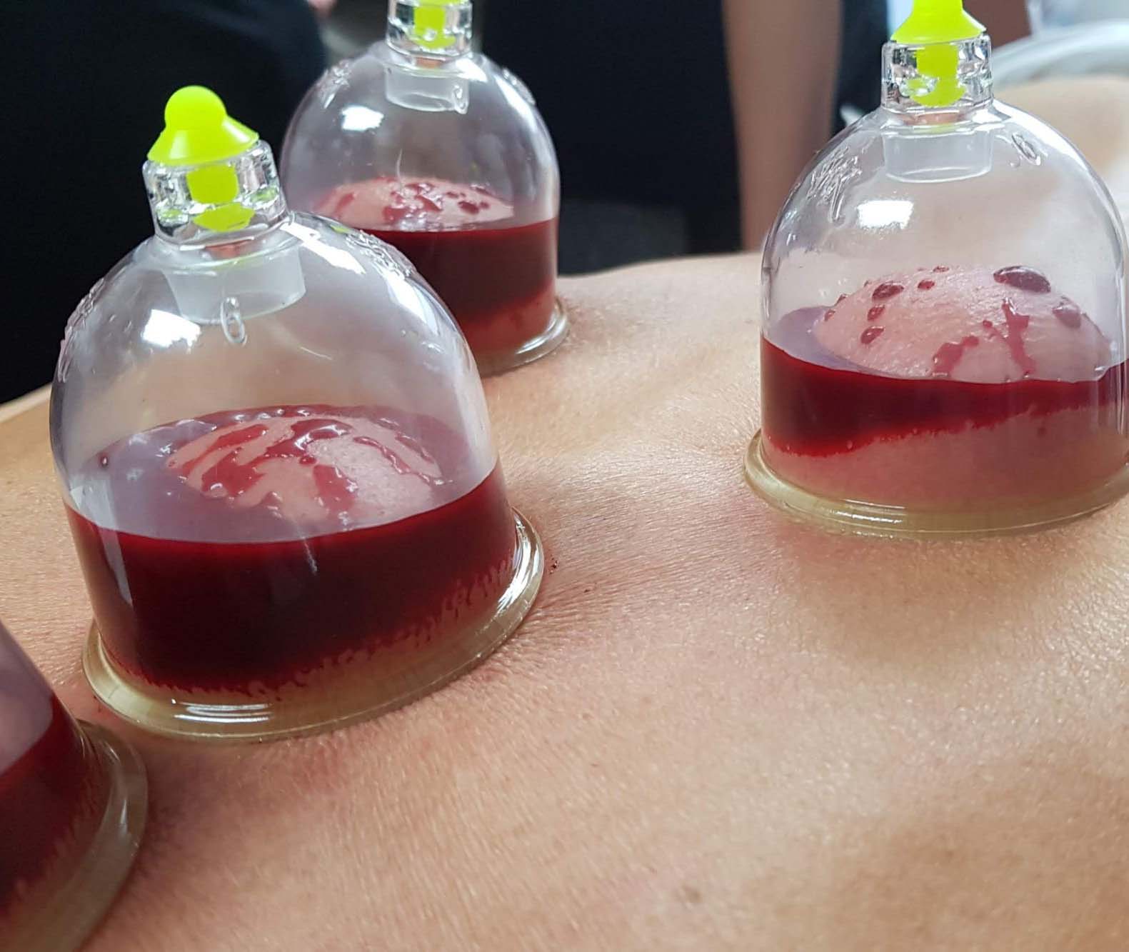 wet cupping